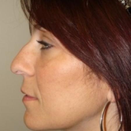 Before image 5 Case #79556 - Rhinoplasty