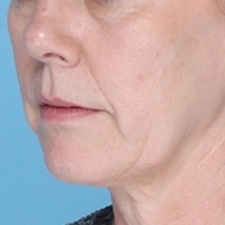 Before image 1 Case #79336 - Non-Surgical Focused Ultrasound