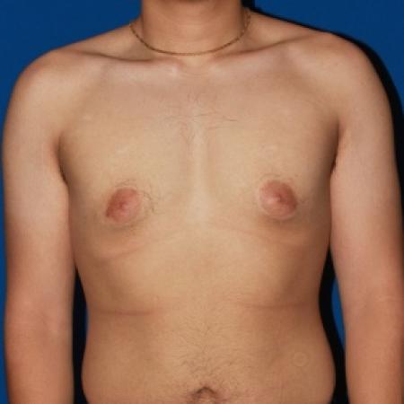 Before image 1 Case #79991 - Gynecomastia male breast reduction