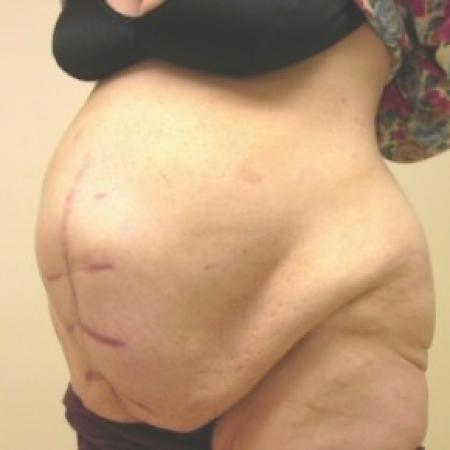 Before image 3 Case #81141 - Abdominoplasty with ventral hernia repair