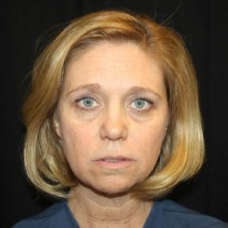 Before image 1 Case #83761 - Facelift - 49 year old female.