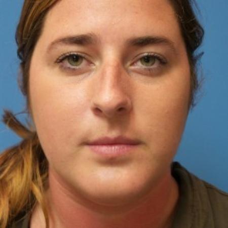 Before image 1 Case #86451 - Rhinoplasty/Septoplasty/Turbinectomy