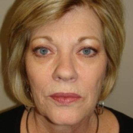 Before image 1 Case #79061 - Upper and lower Eyelid Surgery