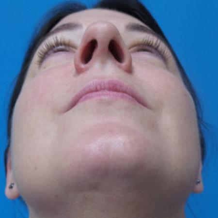 Before image 4 Case #88206 - 40 year old  -  Rhinoplasty & Septoplasty  -  1 month post-op