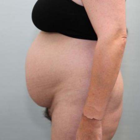 Before image 3 Case #86546 - BAND Abdominoplasty