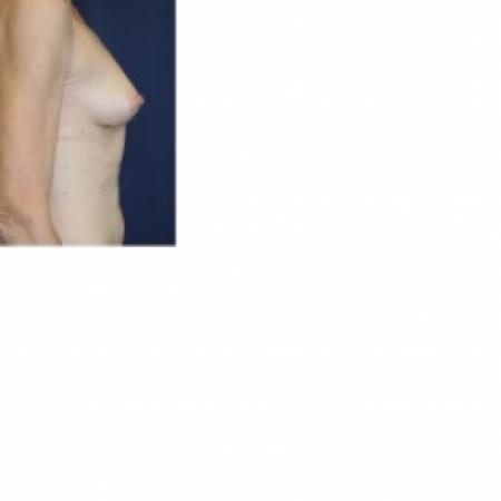 Before image 2 Case #81266 - Breast Augmentation