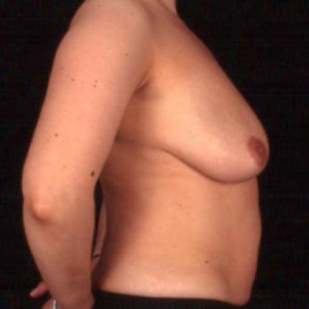 Before image 3 Case #81481 - Breast Augmentation