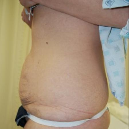Before image 3 Case #85811 - Traditional abdominoplasty after children
