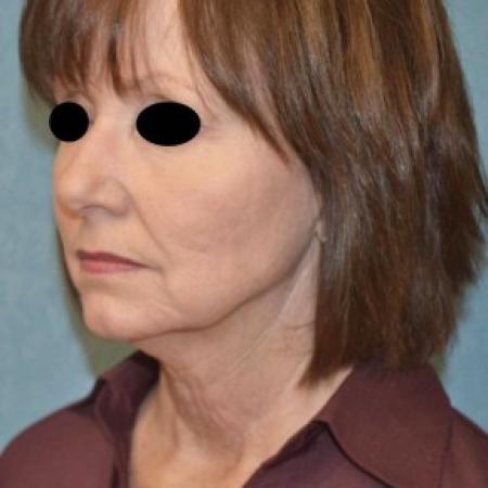 Before image 1 Case #81371 - Lower Face and Neck Lift 