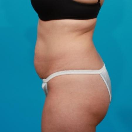 Before image 3 Case #80771 - Tummy Tuck & Flank Liposuction