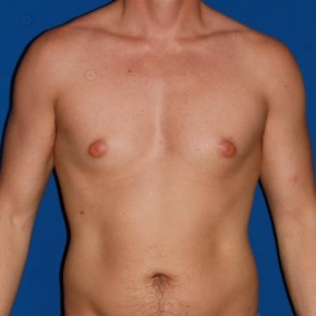 Before image 1 Case #79986 - Gynecomastia male breast reduction