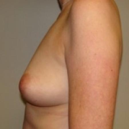 Before image 3 Case #79366 - Breast Augmentation