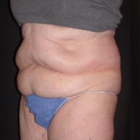 Before image 2 Case #81861 - CoolSculpting