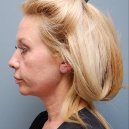 Before image 2 Case #82826 - Face Lift, Neck Lift, and Endoscopic Forehead Lift 
