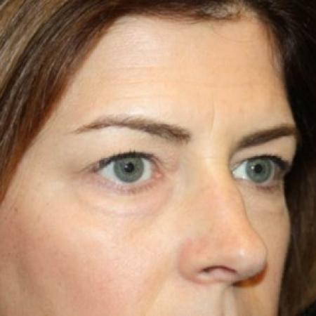 Before image 2 Case #85171 - Blepharoplasty and Browlift - 45 year old female