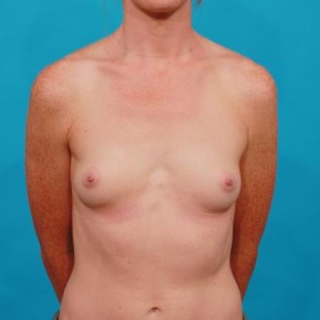 Before image 1 Case #84041 - Silicone Breast Augmentation