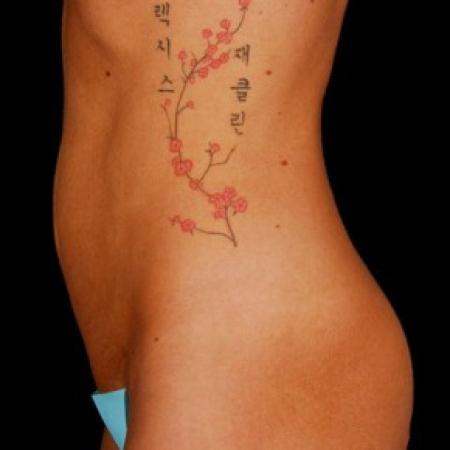 Before image 3 Case #81571 - Tummy Tuck