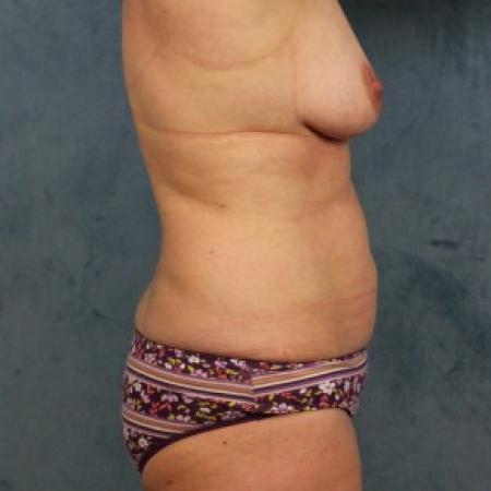 Before image 3 Case #86256 - Mommy makeover with volume preserving breast lift and tummy tuck to correct post pregnancy changes 