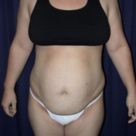 Before image 1 Case #79816 - Tmmy Tuck/ Lipo-Abdominoplasty