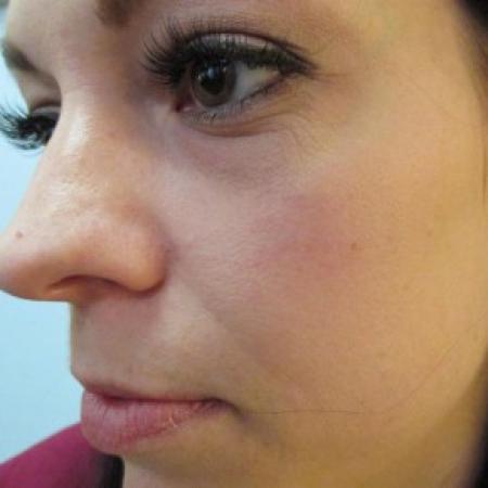 Before image 2 Case #82706 - Fat Transfer to lower lids