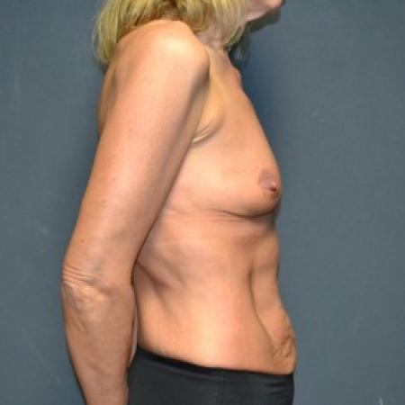 Before image 2 Case #83481 - 49 Years Old Female 