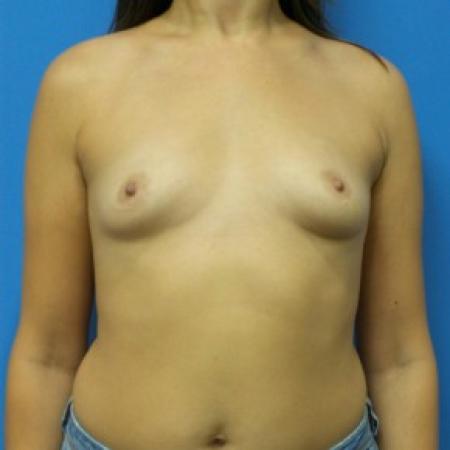 Before image 1 Case #86631 - Submuscular Breast Augmentation 315cc High Cohesive - Medium Height - Moderate Projection Silicone Gel Implants