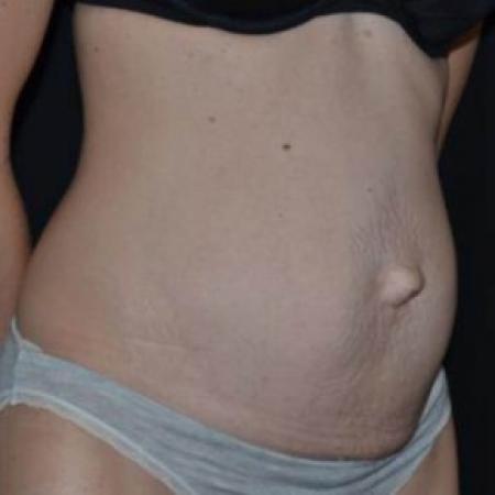 Before image 2 Case #84861 - Abdominoplasty - 42 year old female