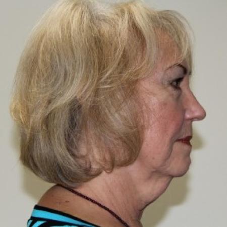 Before image 3 Case #84626 - Lower facelift, necklift and browlift with SMAS grafting to Nasolabial folds