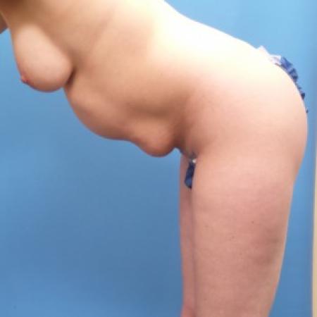 Before image 3 Case #86666 - Abdominoplasty/Liposuction - 3 months post-op