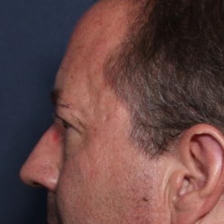 Before image 2 Case #84941 - 58 Years Old Male