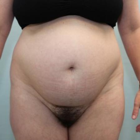 Before image 1 Case #86546 - BAND Abdominoplasty