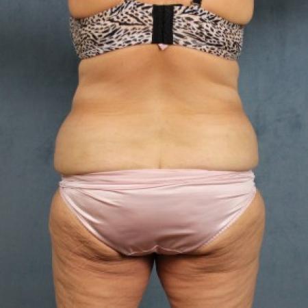 Before image 4 Case #82551 - extended abdominoplasty (tummy tuck) after massive weight loss