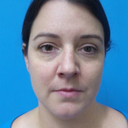 Before image 1 Case #88206 - 40 year old  -  Rhinoplasty & Septoplasty  -  1 month post-op