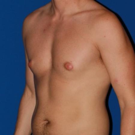Before image 2 Case #79986 - Gynecomastia male breast reduction