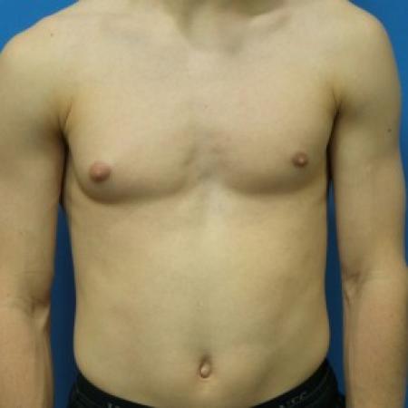 Before image 1 Case #87306 - 17-year old  -  Excisional Gynecomastia right breast
