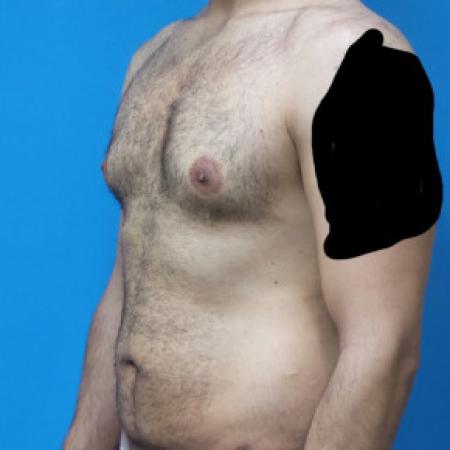 Before image 2 Case #88446 - 34 year old  -  Gynecomastia Reduction/Circumferential Body Lift -  3 months post-op 