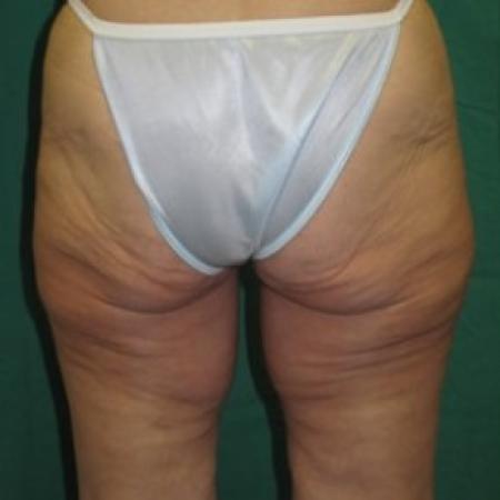 Before Case #85671 - Thigh Lift 