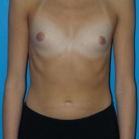 Before image 1 Case #86421 - Submuscular Breast Augmentation 295cc High Cohesive Silicone Gel Implants