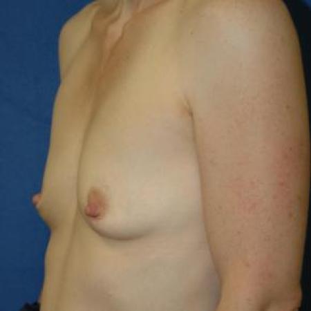 Before image 2 Case #80886 - Breast Augmentation 