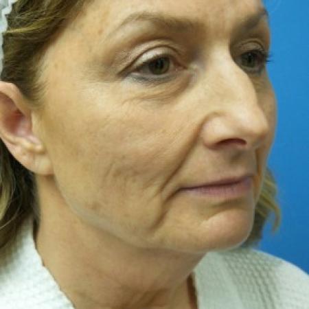 Before image 2 Case #87171 - 55 year old  -  Facelift  -   3 month post-op
