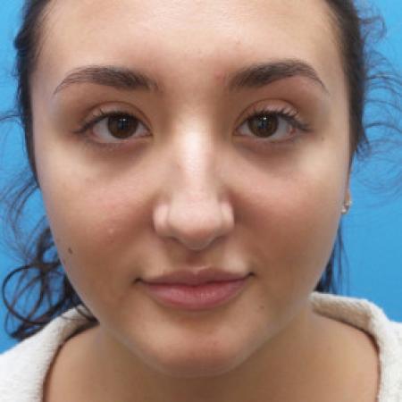 Before image 1 Case #88381 - 21 year-old  -  Rhinoplasty  -  4 months post-op