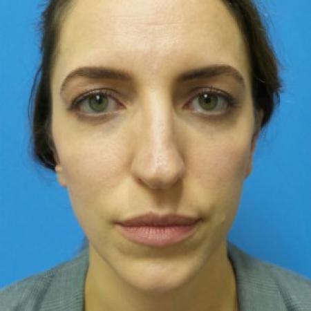Before image 1 Case #87411 - 31 year-old  -  Open Rhinoplasty/Endoscopic Browlift  -  3 months post-op
