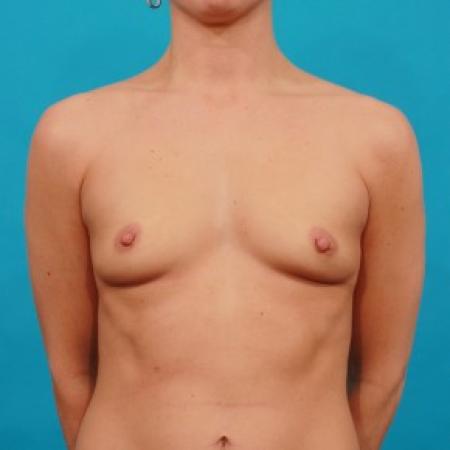 Before image 1 Case #84021 - Silicone Breast Augmentation