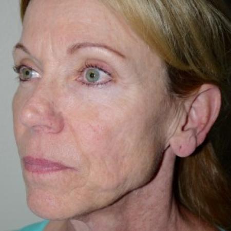 Before image 2 Case #82441 - 56 year old with facial wrinkles, history of acne scarring