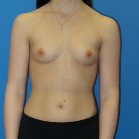 Before image 1 Case #84551 - Breast Augmentation