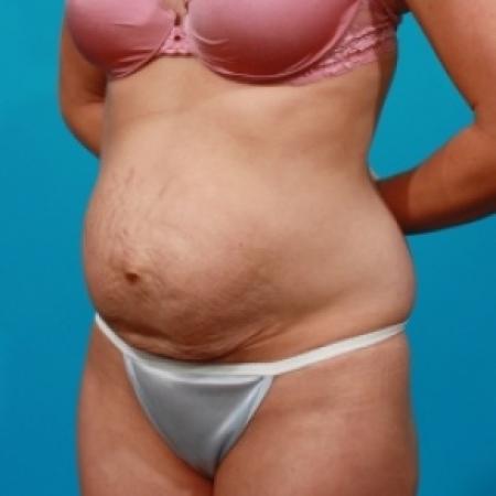Before image 2 Case #78946 - Tummy Tuck & Flank Lipo