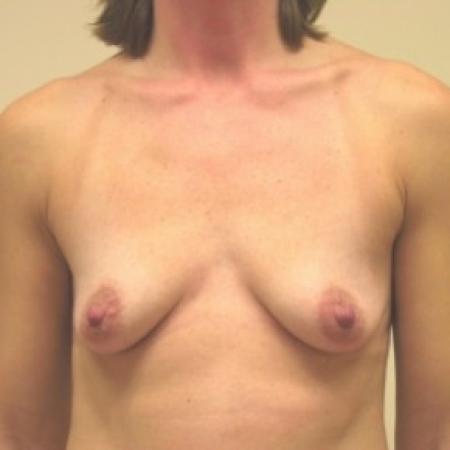 Before image 1 Case #81006 - Breast Augmentation