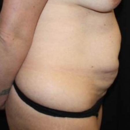 Before image 3 Case #84621 - Abdominoplasty - 35 year old female