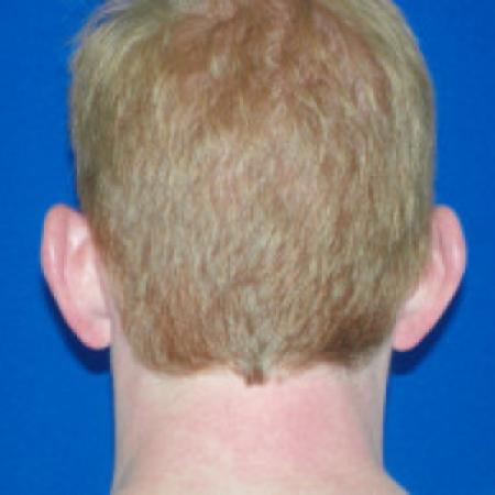 Before image 2 Case #88341 - Otoplasty