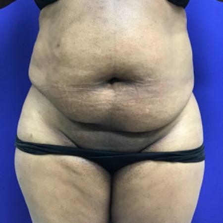 Before image 1 Case #88281 - Tummy Tuck and Liposuction